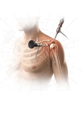 Shoulder Surgery