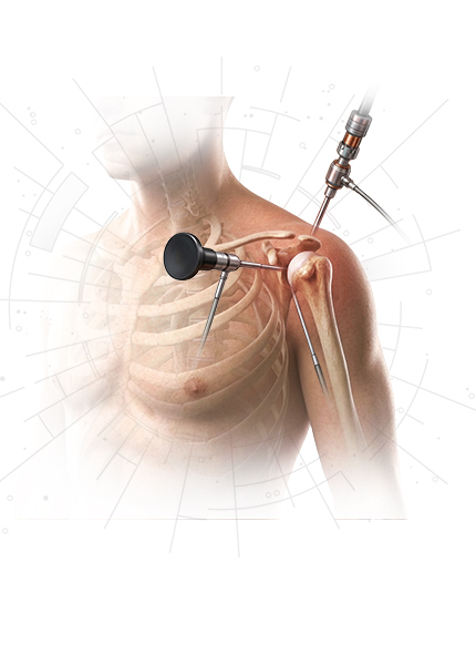 Shoulder Surgery